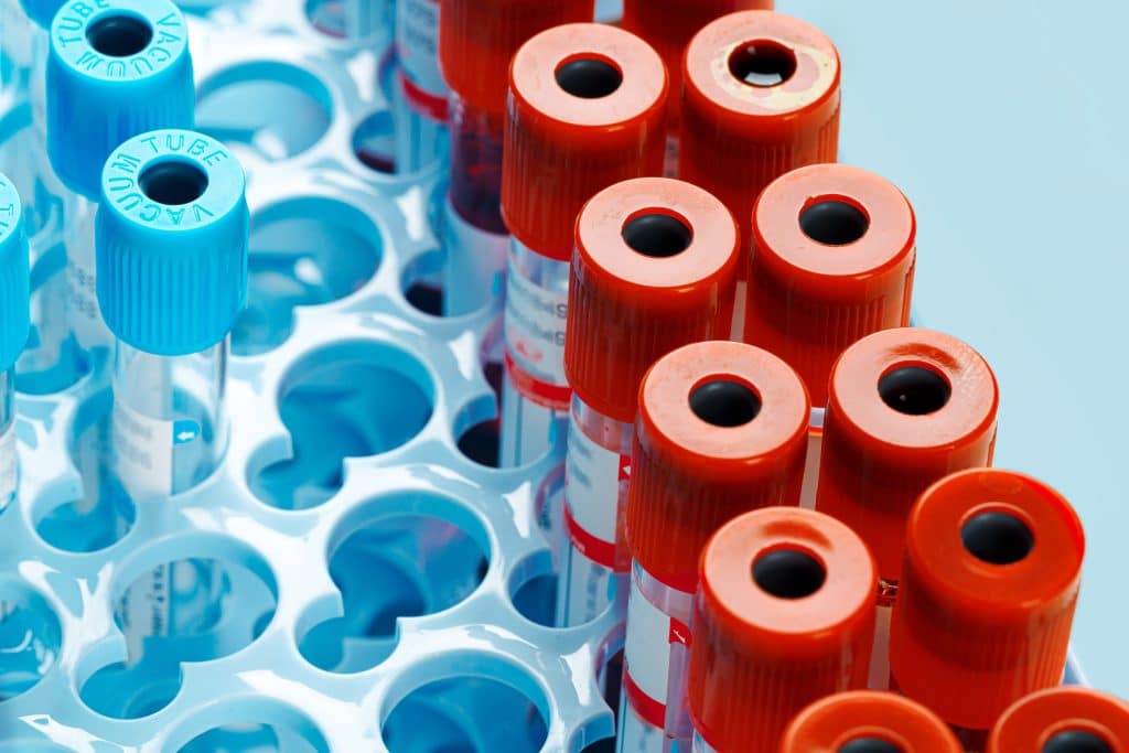 Anilocus a premier preclinical in vivo CRO discusses the difference between plasma and serum. In this image of blood sample test tubes, the tubes with the light blue, cyan color blood collection tubes are for plasma and contain sodium citrate additive. The red-top blood collection tubes are for serum. They do not contain additives. 